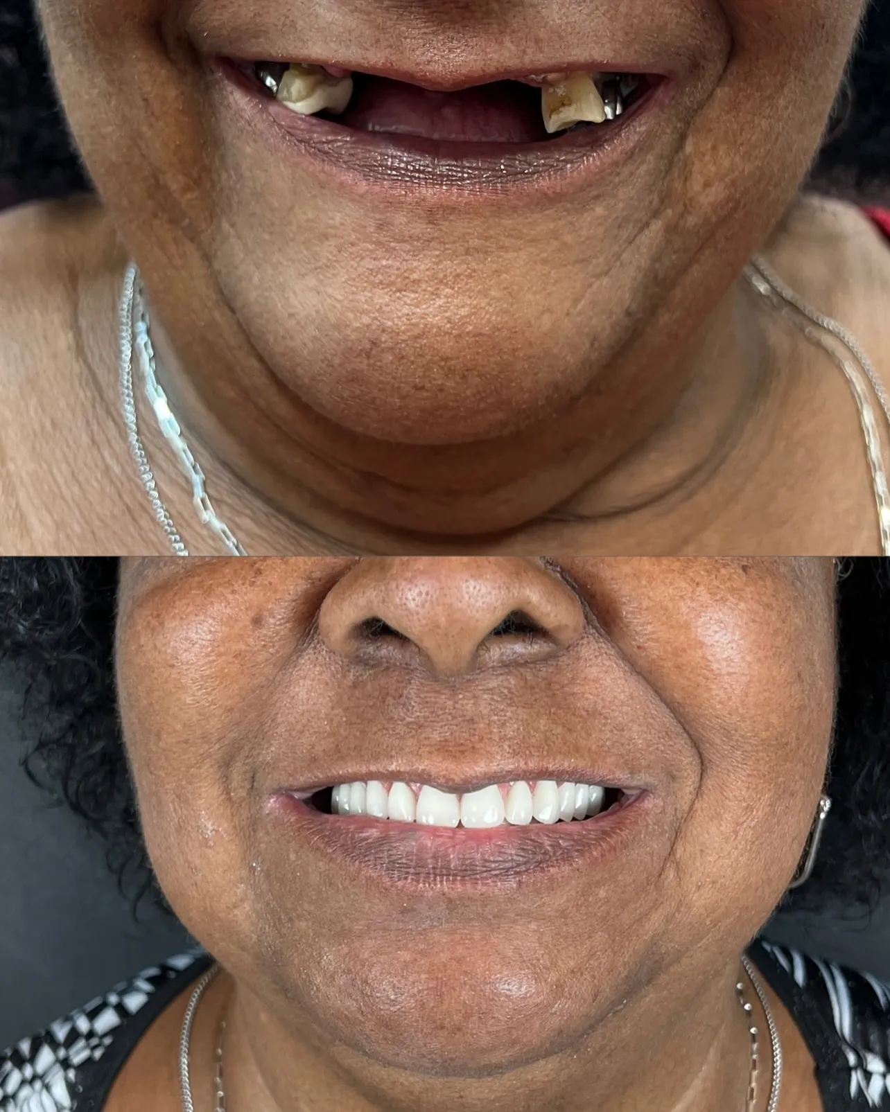 Transformação de Sorriso com Implantes Dentários - Antes e Depois